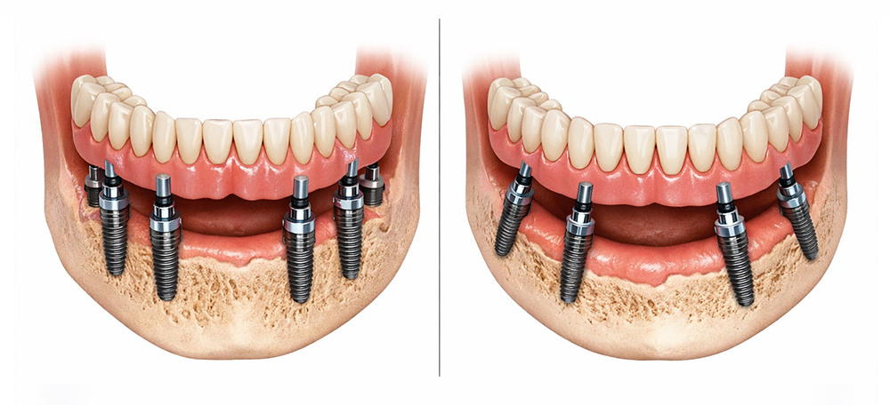 All on 4 Dental Implants 